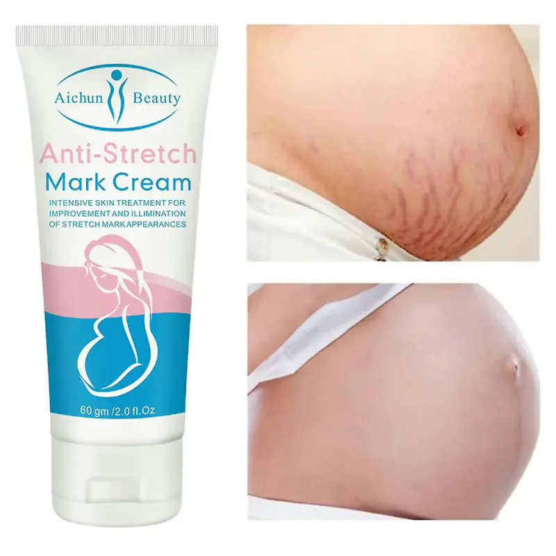 Aichun Beauty Anti-Stretch Marks Cream | Stretch Marks Removal Cream